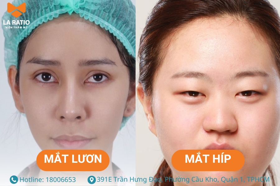 Mắt lươn dài và hẹp trong khi đó mắt híp thì lại có nếp mí rõ ràng hơn