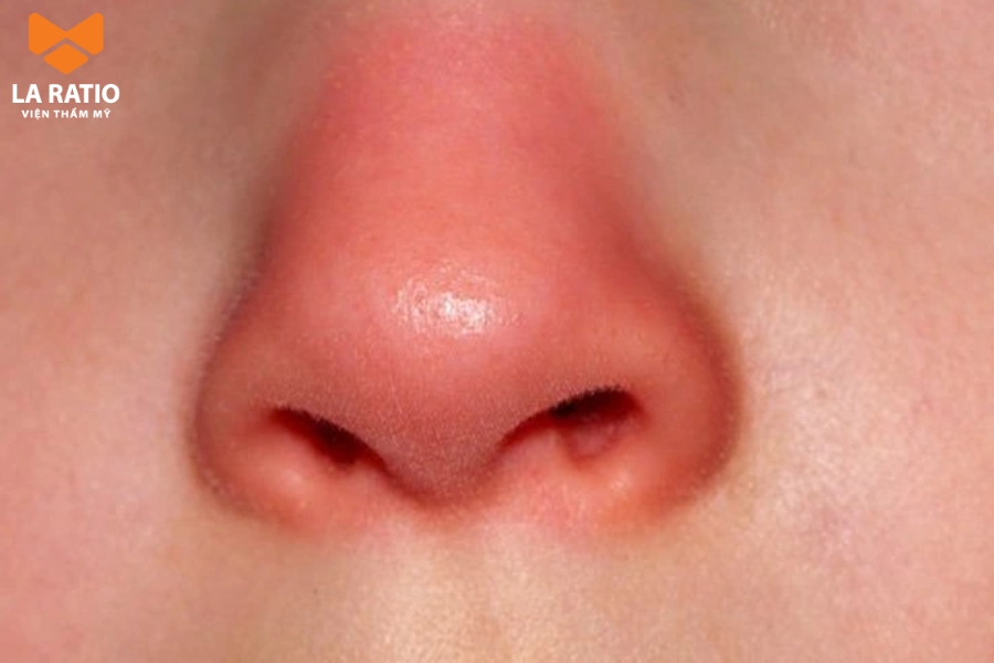 Mũi đỏ cà chua có phần cánh mũi to bè và lỗ mũi rộng hơn bình thường