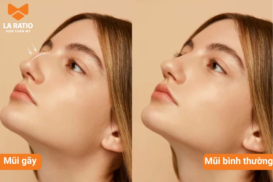 So với dáng mũi thông thường, mũi gãy sẽ có điểm bị gãy khúc, đứt đoạn hoặc gồ cao