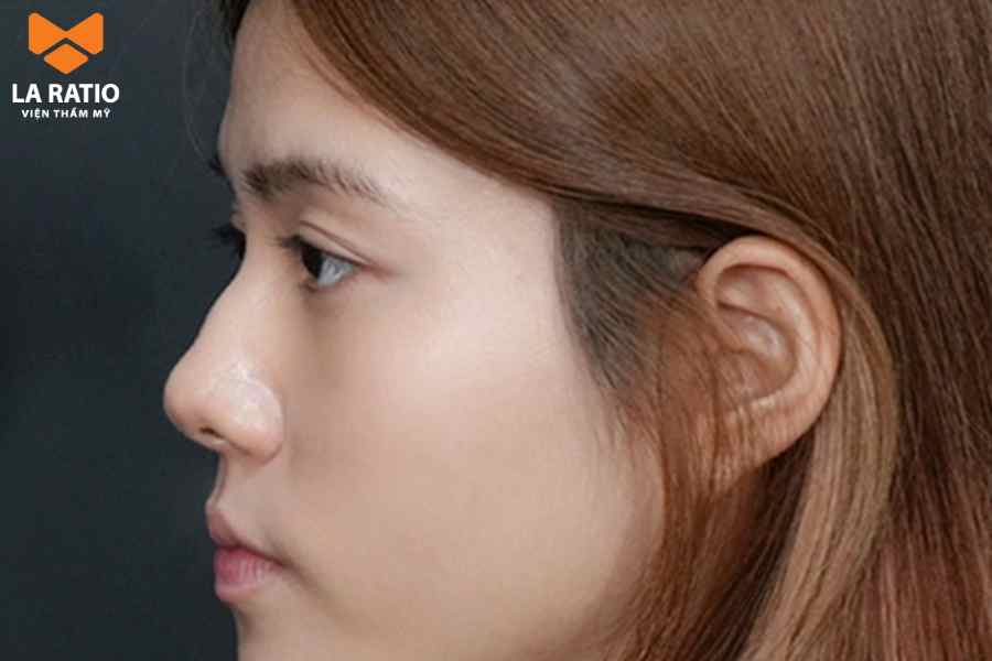 Mũi gồ không được đánh giá là dáng mũi đẹp