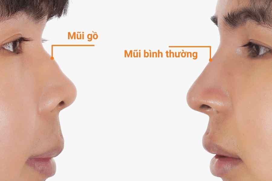 Mũi gồ có phần sống mũi bị nhô lên bất thường