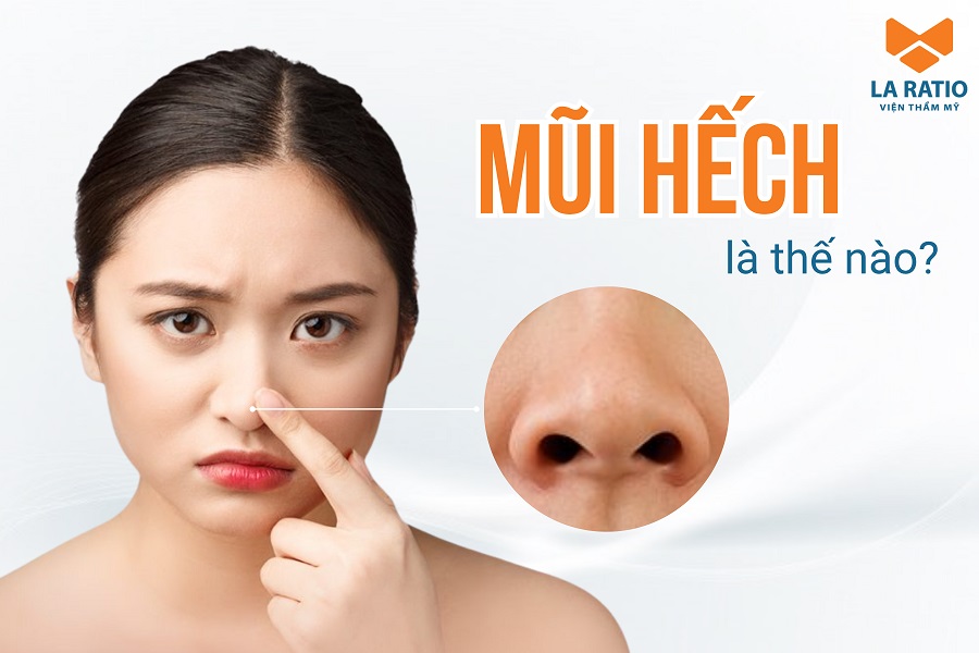 Mũi hếch là gì? Ý nghĩa tướng số và cách khắc phục mũi hếch Mũi hếch là gì? Ý nghĩa tướng số và cách khắc phục mũi hếch