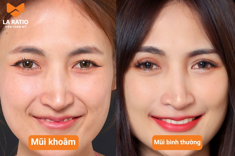 Mũi khoằm có hình dáng tựa như mũi của con chim ưng với phần đầu mũi chúc xuống và quặp vào miệng