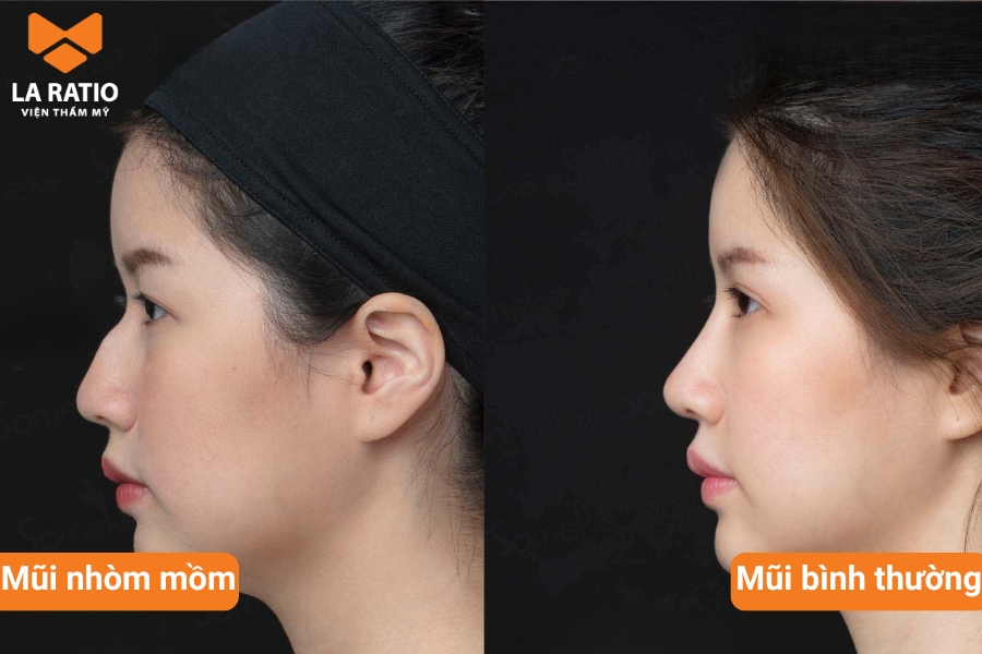 Mũi dòm mồm là gì? Đây là dáng mũi cao nhưng đầu mũi quặp xuống Mũi dòm mồm là gì? Đây là dáng mũi cao nhưng đầu mũi quặp xuống