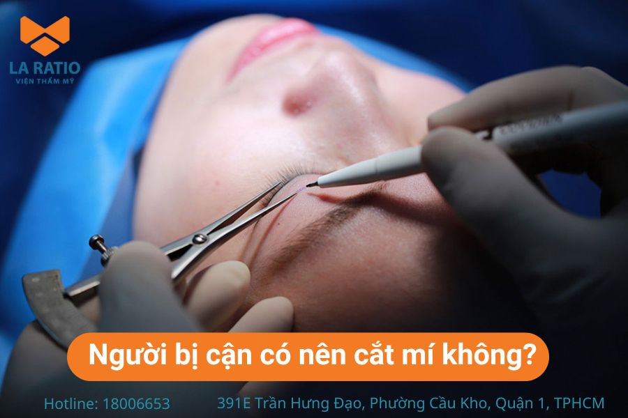 Người bị cận có nên cắt mí không? Theo chuyên gia, người cận vẫn có thể cắt mí 