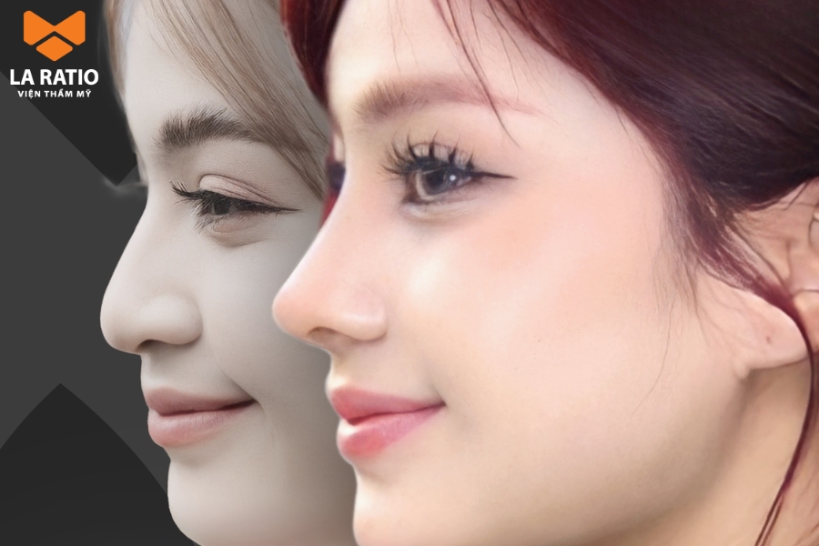 Mũi nhòm mồm có thể được khắc phục bằng kỹ thuật mài xương gồ kết hợp thu gọn đầu mũi Mũi nhòm mồm có thể được khắc phục bằng kỹ thuật mài xương gồ kết hợp thu gọn đầu mũi