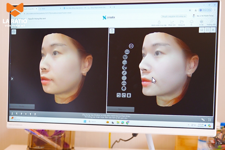Công nghệ mô phỏng dáng mũi trước và sau khi thực hiện - 4D Crisalix