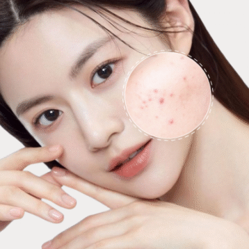 trị mụn bằng thảo dược viện thẩm mỹ la ratio