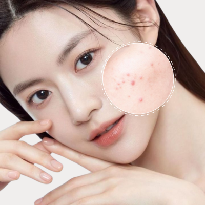 trị mụn bằng thảo dược viện thẩm mỹ la ratio