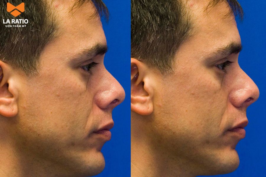 Đàn ông mũi hếch thường là người sống nội tâm và có khả năng quan sát Đàn ông mũi hếch thường là người sống nội tâm và có khả năng quan sát