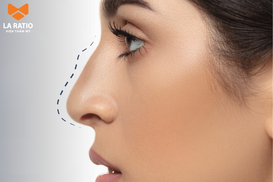 Mũi dòm mồm ở nữ - Tình duyên lận đận, khó tìm được bến đỗ Mũi dòm mồm ở nữ - Tình duyên lận đận, khó tìm được bến đỗ