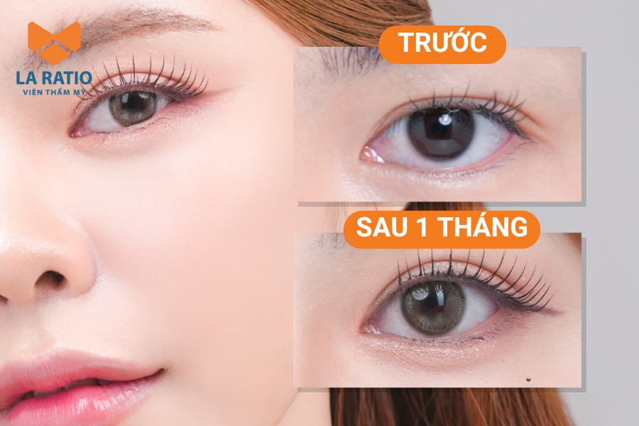 Cắt mí mắt giúp đôi mắt to tròn, long lanh hơn Cắt mí mắt giúp đôi mắt to tròn, long lanh hơn