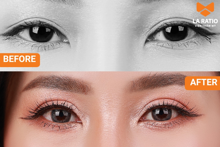 Cắt mí tạo nếp mí mới và tái cấu trúc, định hình lại toàn bộ dáng mắt