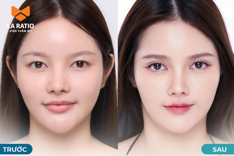 Cắt mí mắt giúp cải thiện dáng mắt dê an toàn với hiệu quả thẩm mỹ lâu dài