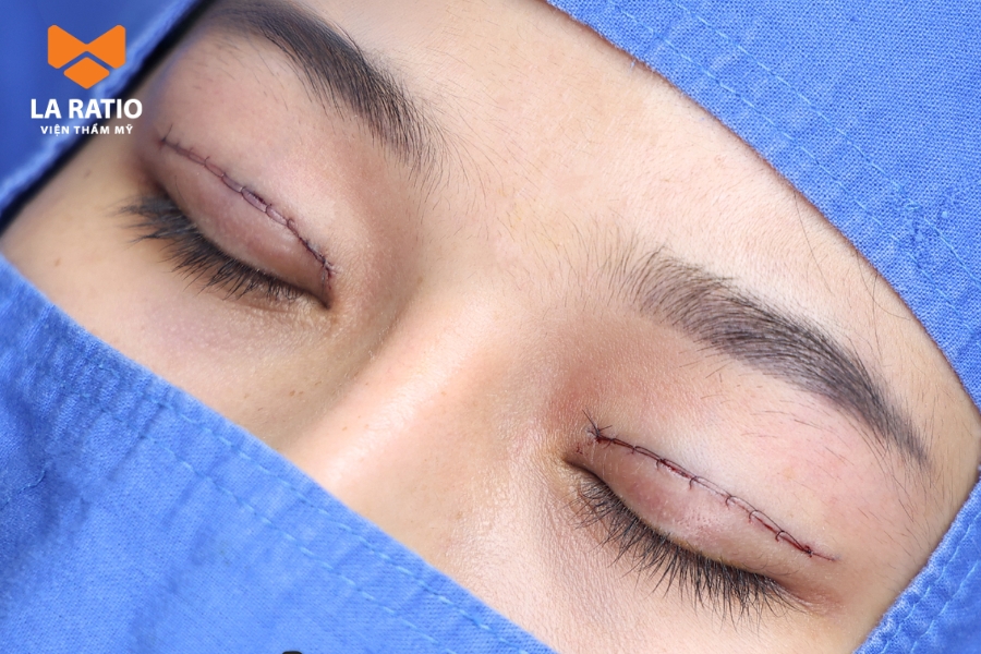 Phẫu thuật thẩm mỹ mang lại hiệu quả lâu dài hơn trong việc cải thiện tình trạng mắt ốc nhồi Phẫu thuật thẩm mỹ mang lại hiệu quả lâu dài hơn trong việc cải thiện tình trạng mắt ốc nhồi