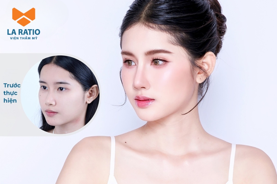 Nâng mũi cao tây tạo sống mũi cao, thẳng và sắc nét Nâng mũi cao tây tạo sống mũi cao, thẳng và sắc nét