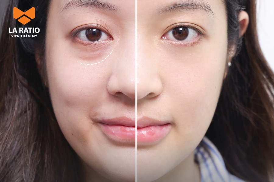 Lấy mỡ mí mắt giúp loại bỏ bọng mắt giúp mắt to, cân đối và sắc nét hơn Lấy mỡ mí mắt giúp loại bỏ bọng mắt giúp mắt to, cân đối và sắc nét hơn