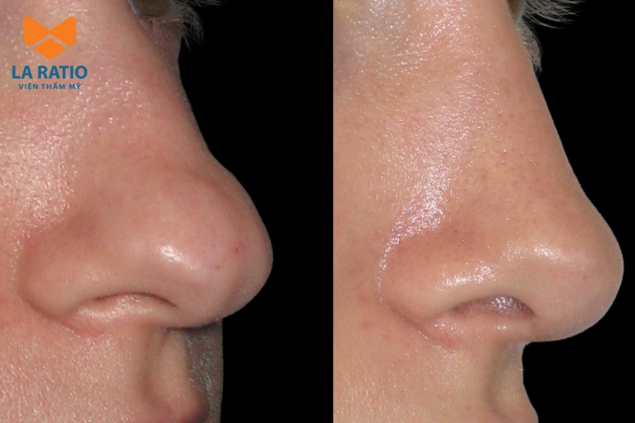 Nếu cảm thấy không hài lòng với dáng mũi hiện tại, bạn có thể chỉnh sửa để mũi hài hòa hơn