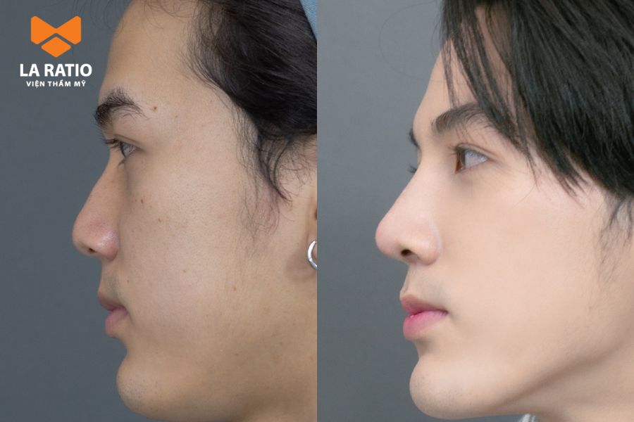 Dáng mũi L Line phù hợp với khuôn mặt có phần góc cạnh Dáng mũi L Line phù hợp với khuôn mặt có phần góc cạnh