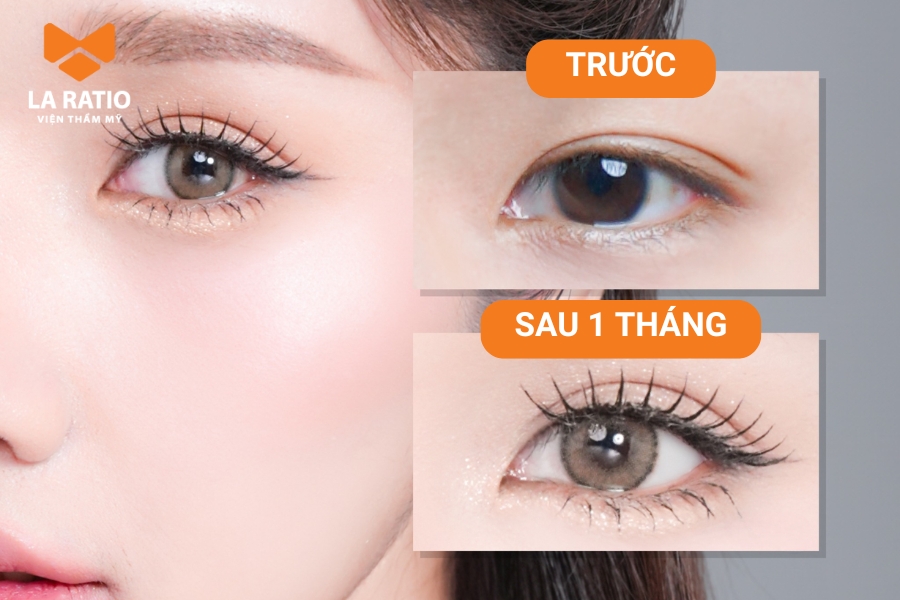 Cắt mí mắt là phương pháp an toàn,hiệu quả lâu dài, giúp tôn lên vẻ đẹp cho đôi mắt ngấn lệ Cắt mí mắt là phương pháp an toàn,hiệu quả lâu dài, giúp tôn lên vẻ đẹp cho đôi mắt ngấn lệ