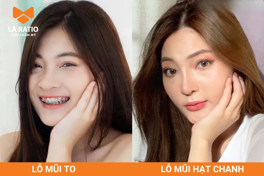 Mũi hạt chanh dù nhìn nghiêng hay thẳng đều không lộ rõ lỗ mũi