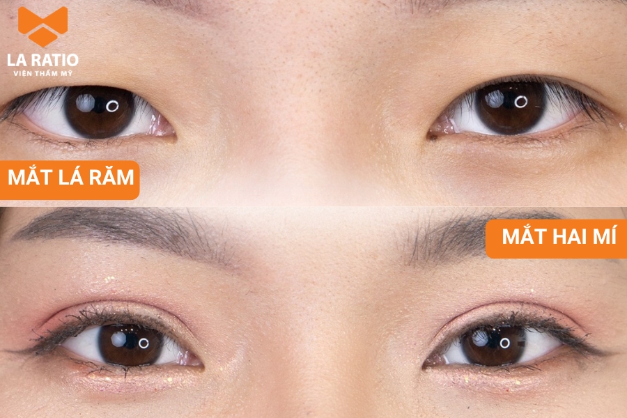 Mắt lá răm là mắt 1 mí nhưng có kích thước to hơn mắt 1 mí thông thường