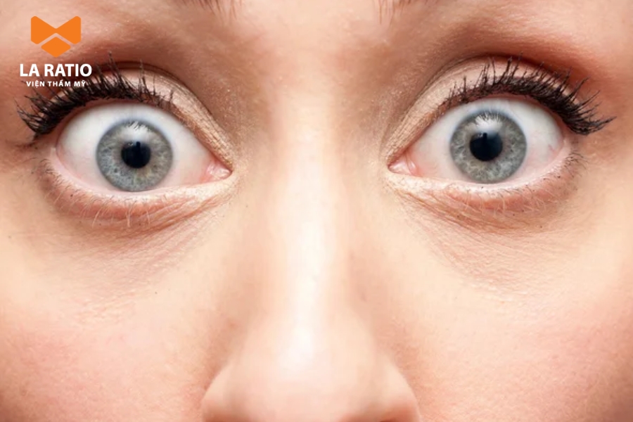 Mắt ốc nhồi được xem là đẹp khi độ lồi không quá 0,7mm Mắt ốc nhồi được xem là đẹp khi độ lồi không quá 0,7mm