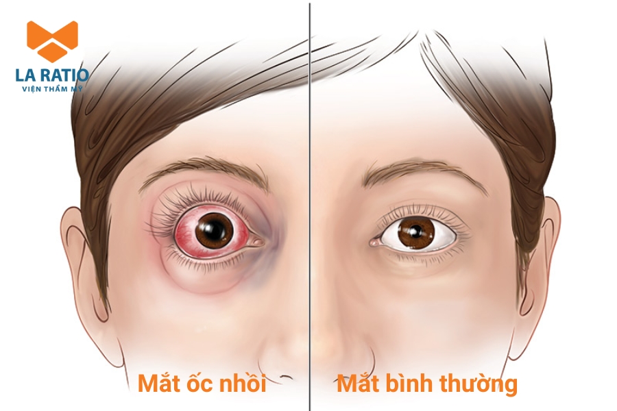Mắt ốc nhồi là sao? Đây là dáng mắt có phần con ngươi lồi ra phía trước Mắt ốc nhồi là sao? Đây là dáng mắt có phần con ngươi lồi ra phía trước