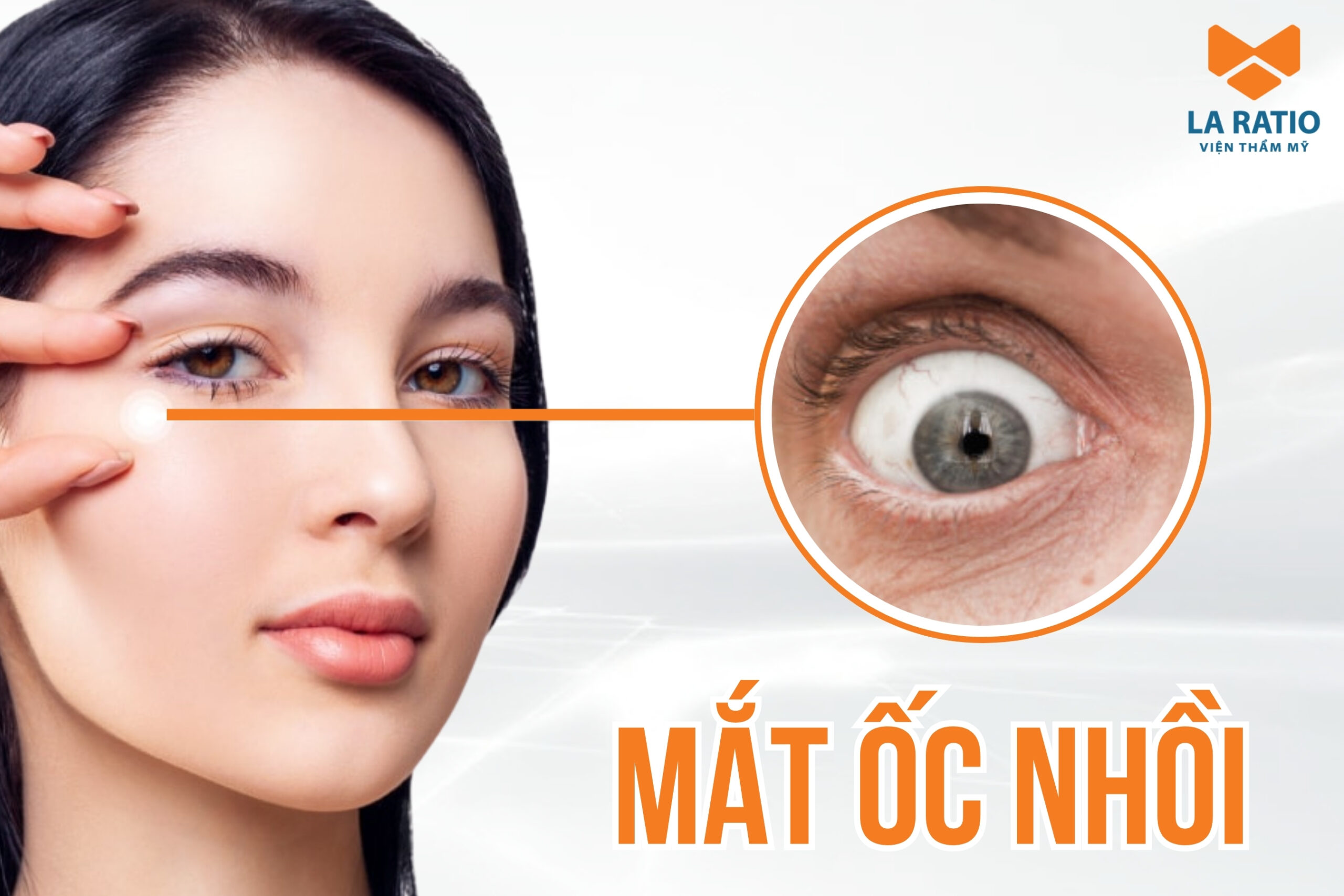 Mắt ốc nhồi là như thế nào? Tướng người mắt ốc nhồi tốt hay xấu? Mắt ốc nhồi là như thế nào? Tướng người mắt ốc nhồi tốt hay xấu?