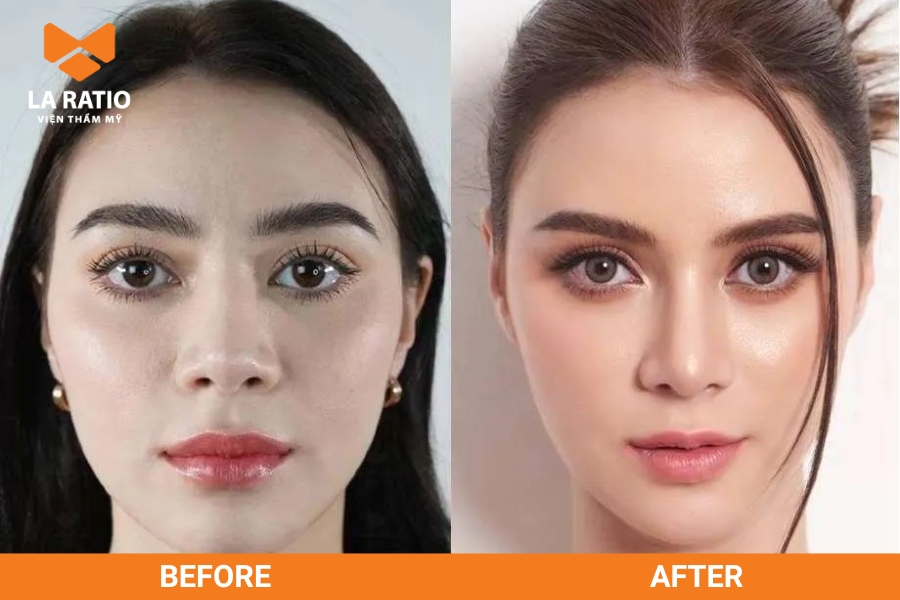 Phẫu thuật thẩm mỹ mũi giúp thu gọn lỗ mũi, tạo sự hài hòa cho toàn bộ dáng mũi