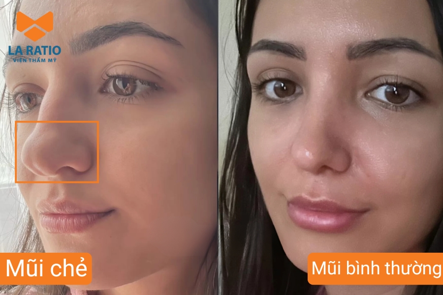 Mũi chẻ là dáng mũi bị chẻ đôi ở đầu mũi