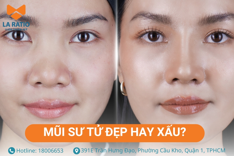 Xét theo thẩm mỹ, mũi sư tử thường khiến gương mặt trở nên kém cân đối