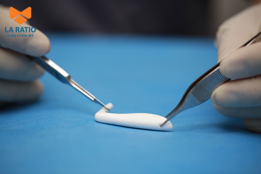 Nâng mũi L Line bằng sụn nhân tạo là sự lựa chọn của nhiều khách hàng Nâng mũi L Line bằng sụn nhân tạo là sự lựa chọn của nhiều khách hàng