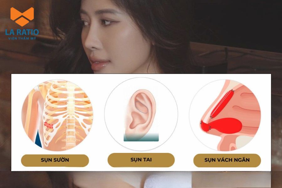 Nâng mũi L Line bằng sụn tự thân có thể giúp hạn chế tình trạng đào thải Nâng mũi L Line bằng sụn tự thân có thể giúp hạn chế tình trạng đào thải