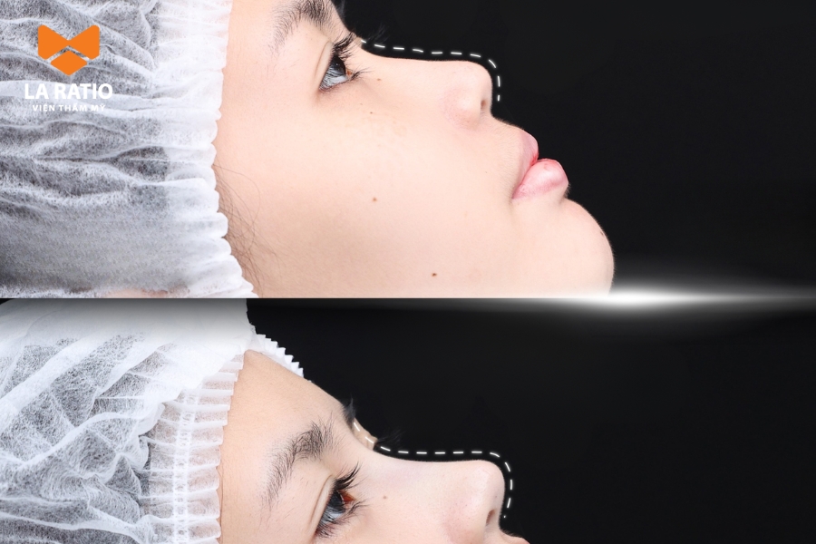 Nâng mũi bọc sụn S-Line phù hợp với những ai có da mũi dày