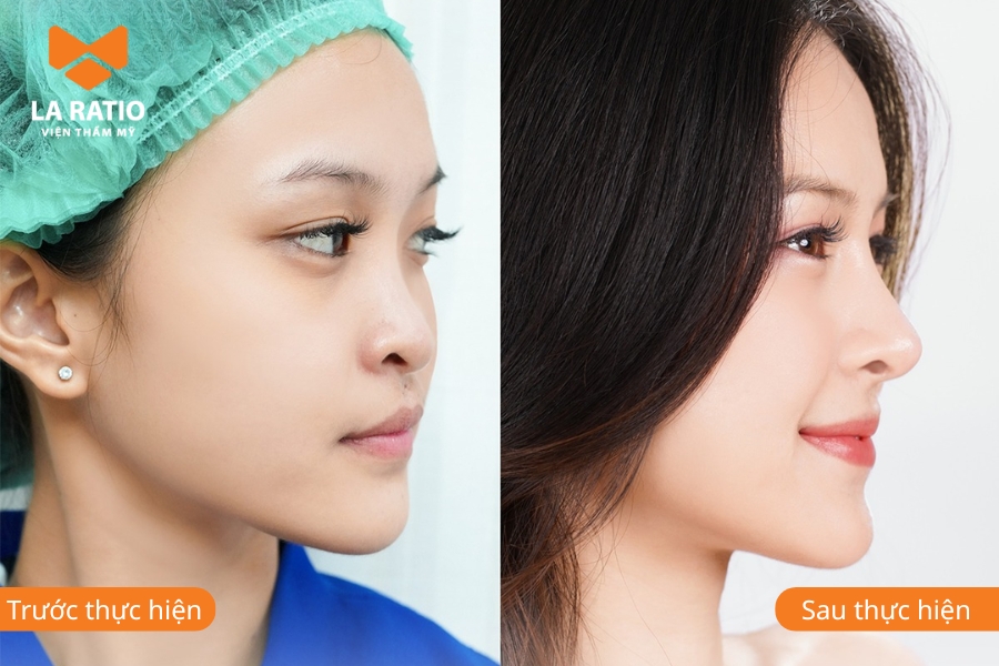 Nâng mũi không băng nẹp có bị lệch không? Câu trả lời là không vì toàn bộ cấu trúc đã được cố định chắc chắn Nâng mũi không băng nẹp có bị lệch không? Câu trả lời là không vì toàn bộ cấu trúc đã được cố định chắc chắn