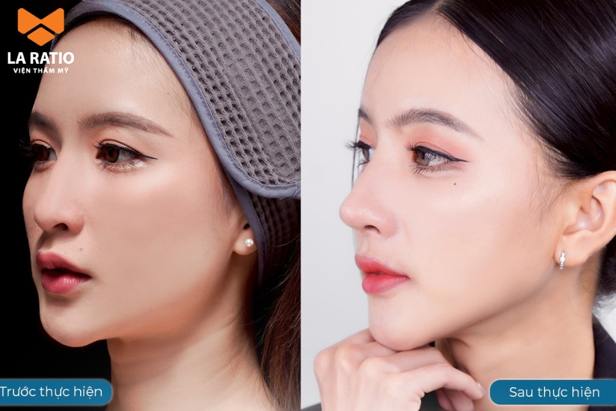 Không có dáng mũi nào đẹp hơn, quan trọng là dáng mũi nào phù hợp với bạn 