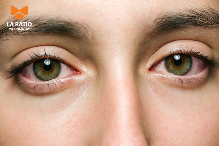 Hơn 90% mắt ốc sên là do di truyền Hơn 90% mắt ốc sên là do di truyền