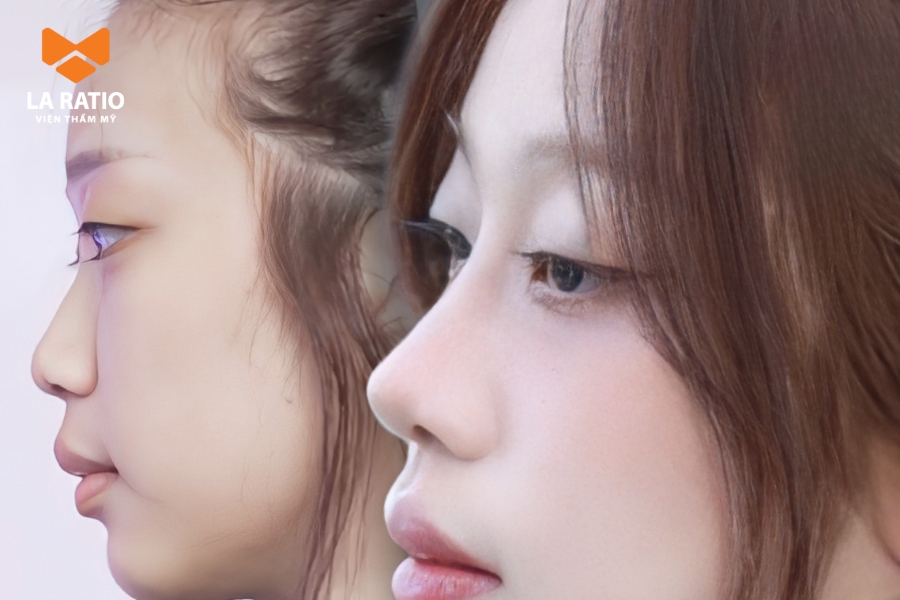 Nâng mũi S-Line mang lại vẻ đẹp tự nhiên, phù hợp với nhiều đối tượng khách hàng