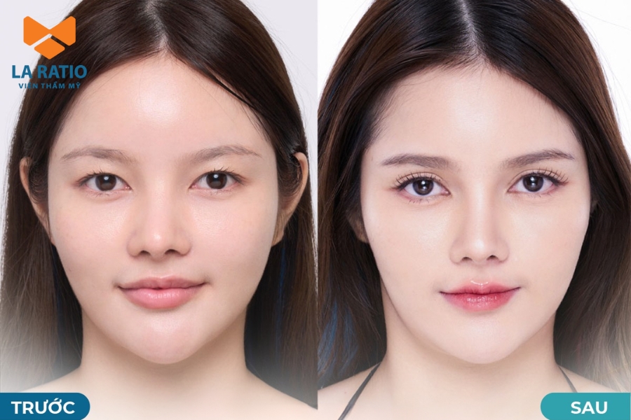 Thẩm mỹ mắt cười giúp tạo hình đôi mắt to tròn và cuốn hút Thẩm mỹ mắt cười giúp tạo hình đôi mắt to tròn và cuốn hút