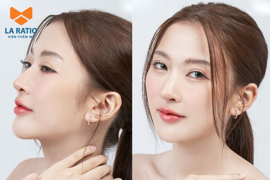 So sánh sơ lược dáng mũi Trung Hoa với các dáng mũi khác So sánh sơ lược dáng mũi Trung Hoa với các dáng mũi khác