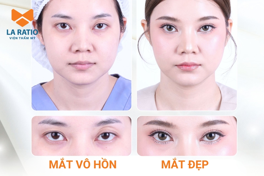 Mắt lờ đờ vô hồn có ánh nhìn thiếu sinh khí, không biểu cảm và gần như không phản chiếu cảm xúc Mắt lờ đờ vô hồn có ánh nhìn thiếu sinh khí, không biểu cảm và gần như không phản chiếu cảm xúc