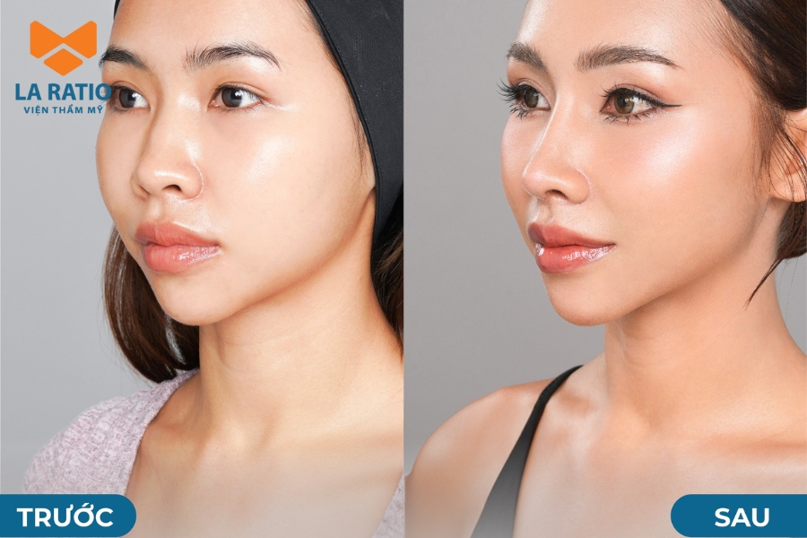 Hình ảnh khách hàng trước và sau khi nâng mũi không băng nẹp tại La Ratio Hình ảnh khách hàng trước và sau khi nâng mũi không băng nẹp tại La Ratio
