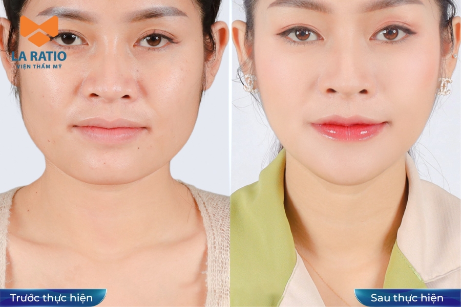 Nâng mũi cấu trúc giúp định hình lại dáng mũi từ sống mũi đến đầu mũi và cánh mũi