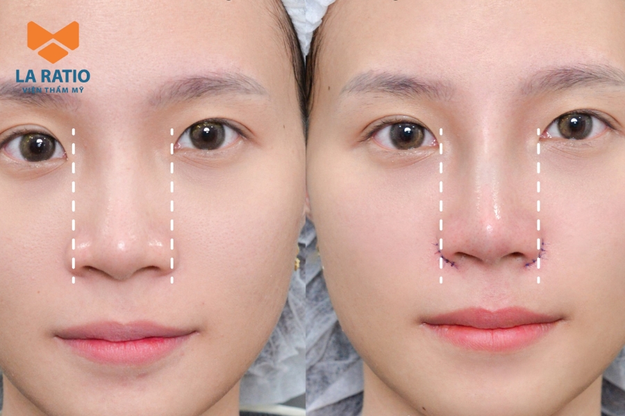 Có thể cân nhắc chỉnh sửa nếu dáng mũi hiện tại chưa hài hòa