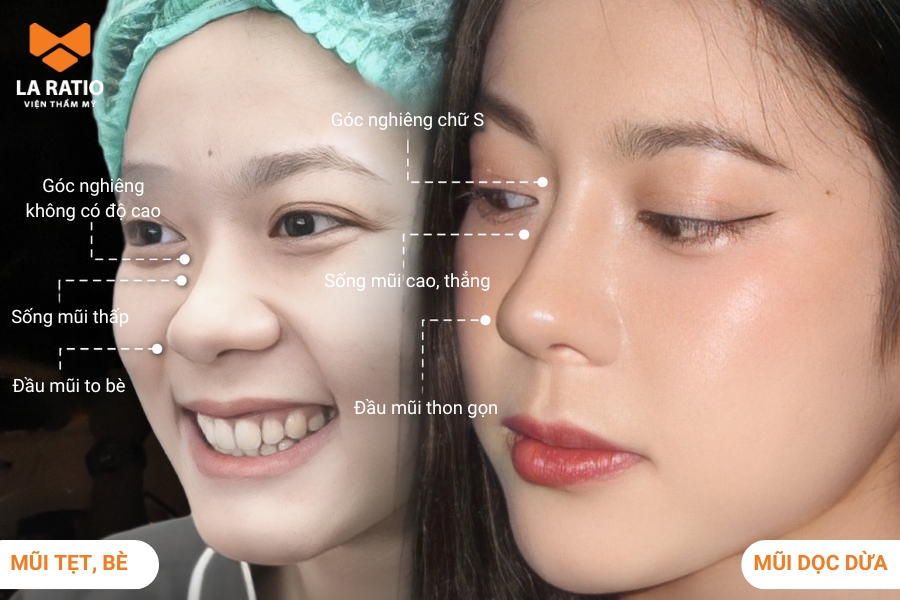 Hình ảnh mũi dọc dừa