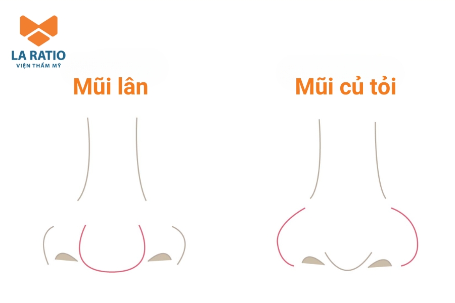 Mũi lân tạo cảm giác khuôn mặt nặng nề hơn so với dáng mũi củ tỏi