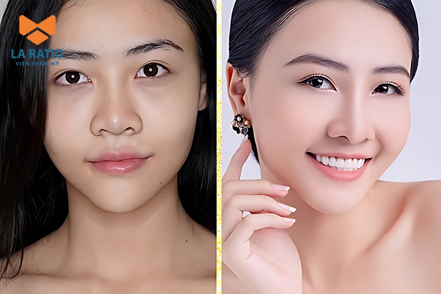 Có nên chỉnh sửa mũi lân không?