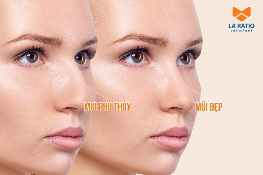 Mũi phù thủy là gì? Đặc điểm nhận biết và cách khắc phục Mũi phù thủy là gì? Đặc điểm nhận biết và cách khắc phục