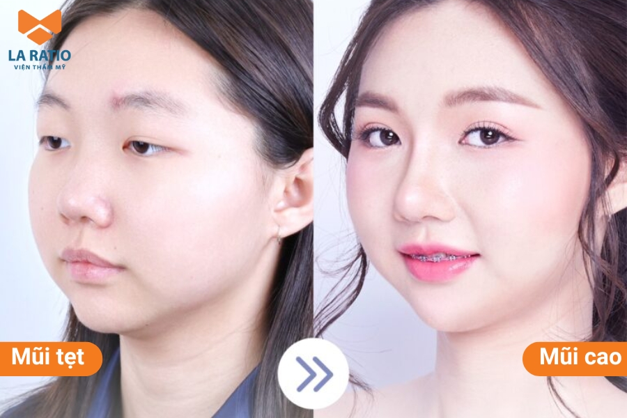 Mũi tẹt không phải là dáng mũi đẹp